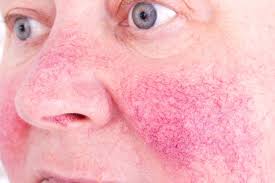 Rosacea mắt - Hình ảnh minh họa